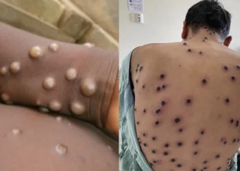 Global Mpox Outbreak Spreads to Broader Demographic, Warns Lancet Report