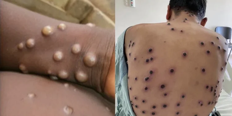 Global Mpox Outbreak Spreads to Broader Demographic, Warns Lancet Report