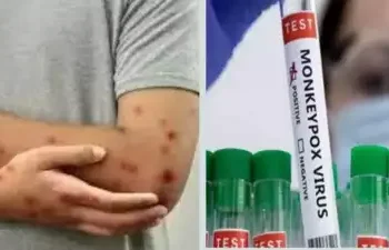 India Reports First Case of Mpox Clade 1 Strain, Declared Public Health Emergency by WHO