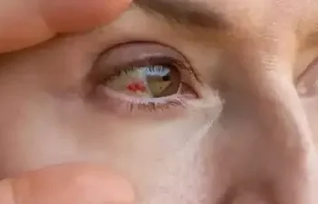 What Is the “Bleeding Eye” Virus? 15 Dead in Rwanda Amid Marburg Outbreak