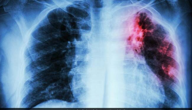 Rate of Tuberculosis Decline Doubles Since 2015: JP Nadda